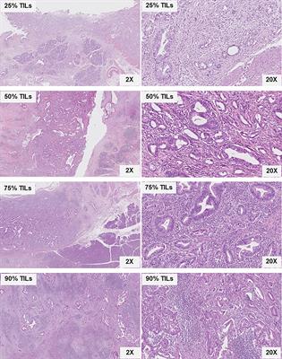 Prognostic significance of tumor-infiltrating lymphocytes in predicting outcome of distal cholangiocarcinoma in Thailand